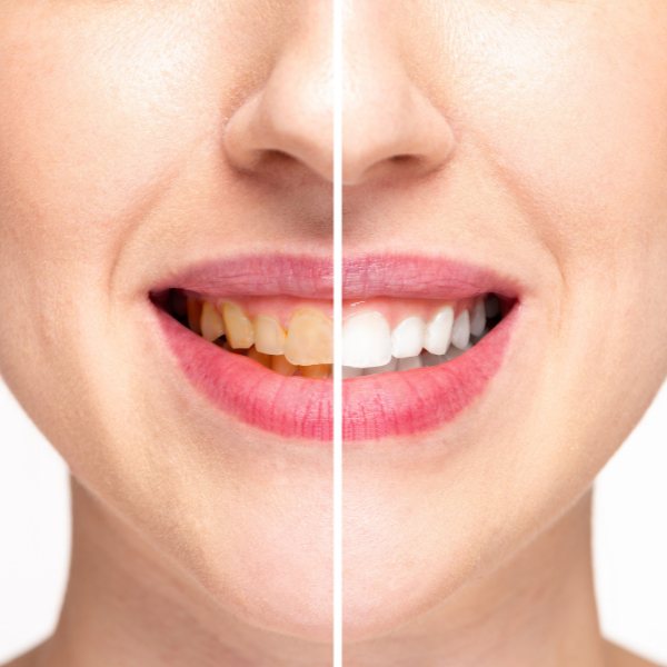 Teeth Whitening