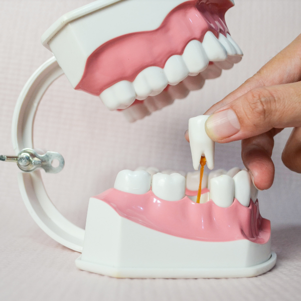Tooth Extractions