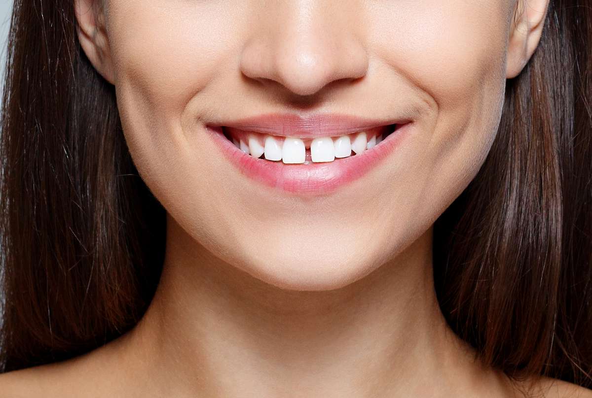 Dental Gaps Or Diastema