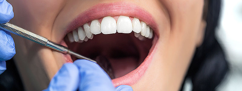 The Myths Of Wisdom Teeth Removal