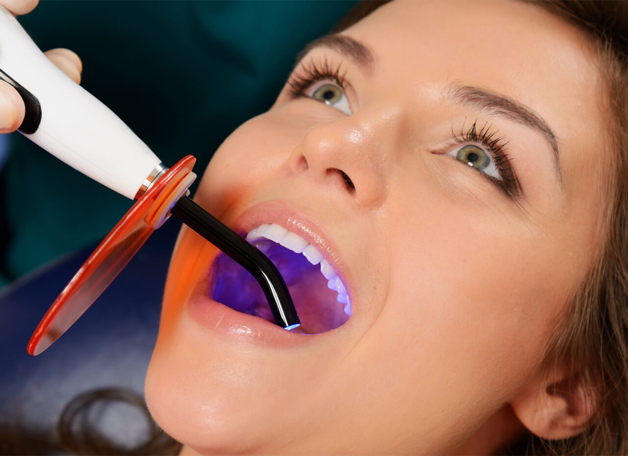 Dental Bonding: What To Do After Dental Bonding Procedure?
