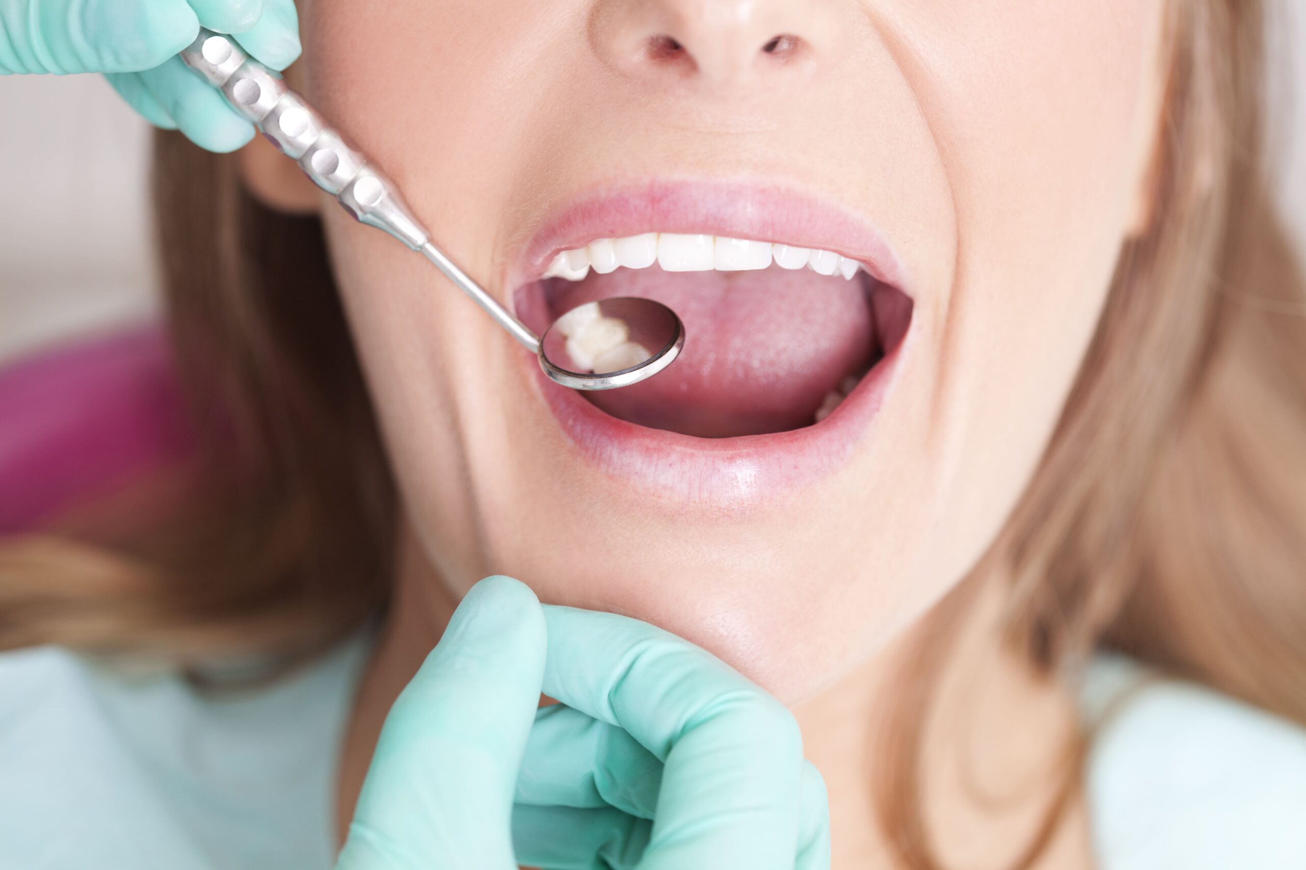 Dental Fillings, Explained!