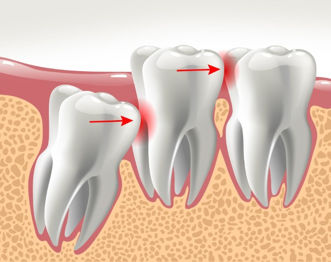How To Know If You Have An Impacted Wisdom Tooth