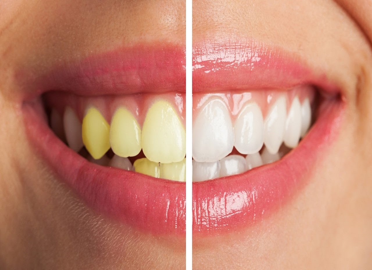 Treatment And Solutions For Teeth Discoloration