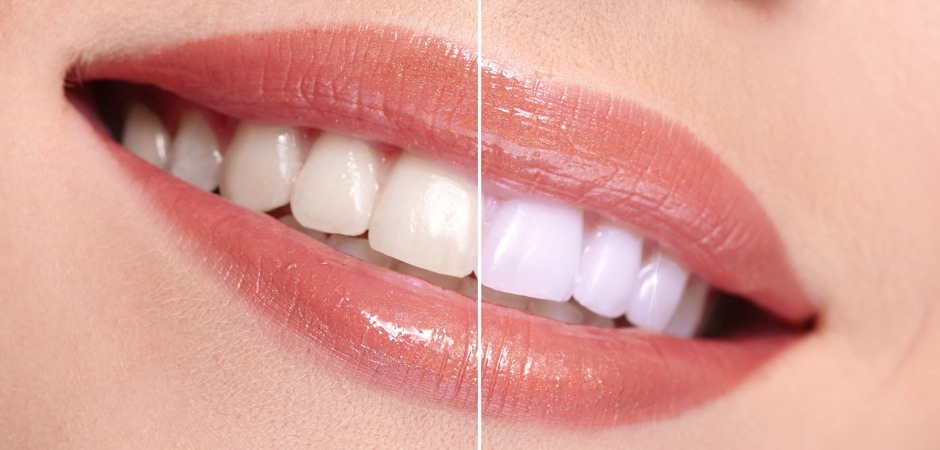 Why Is Teeth Whitening Important?