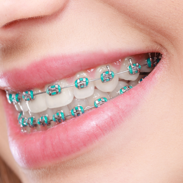 Braces in Richmond Hill