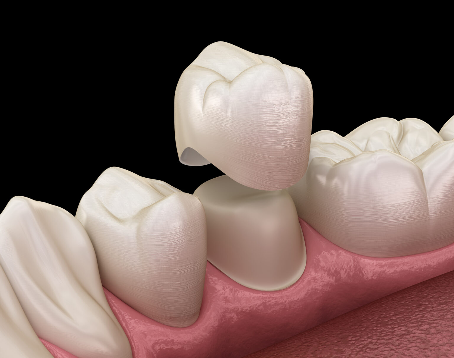 Dental Crowns in Richmond Hill