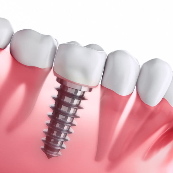 Dental Implants in Richmond Hill