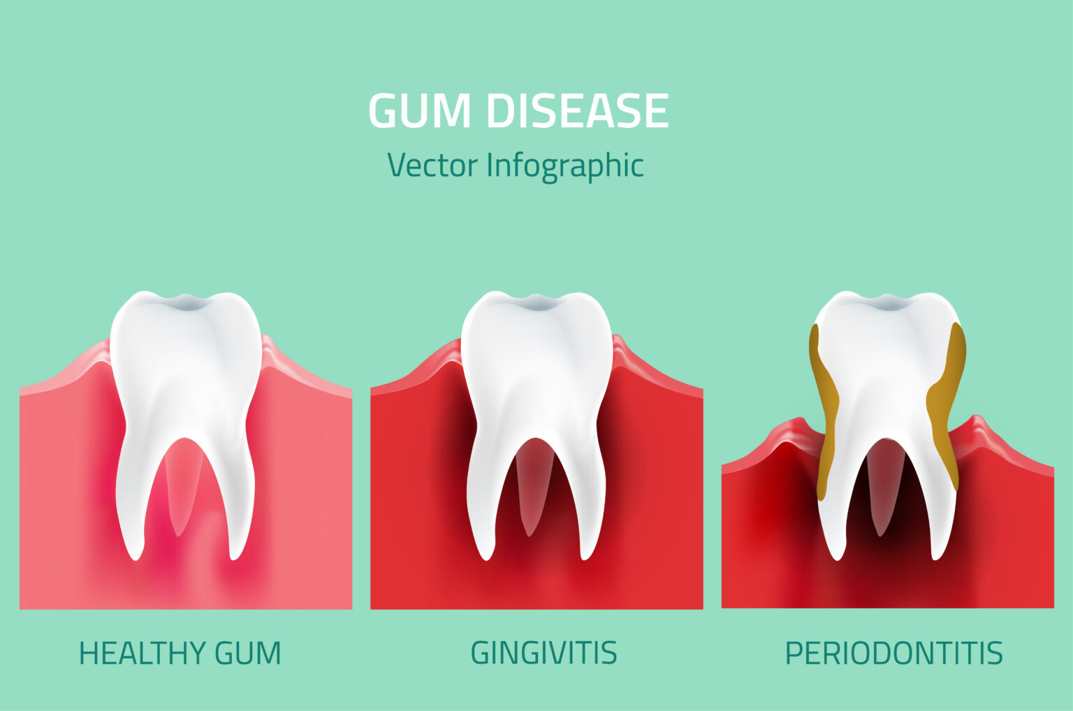 Gum Disease Treatment in Richmond Hill