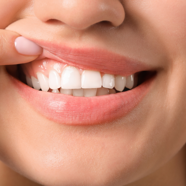 Gum Reduction in Richmond Hill