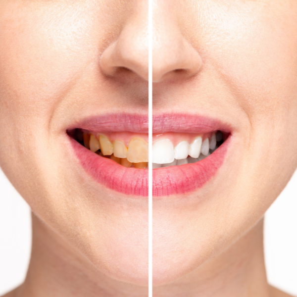 Teeth Whitening in Richmond Hill