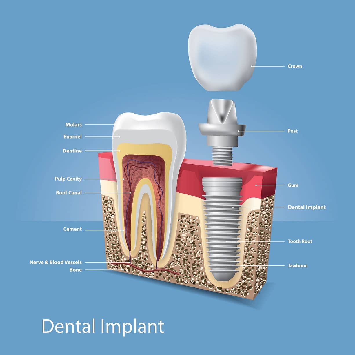 Missing Teeth? Here’s Why Richmond Hill Patients Prefer Dental Implants