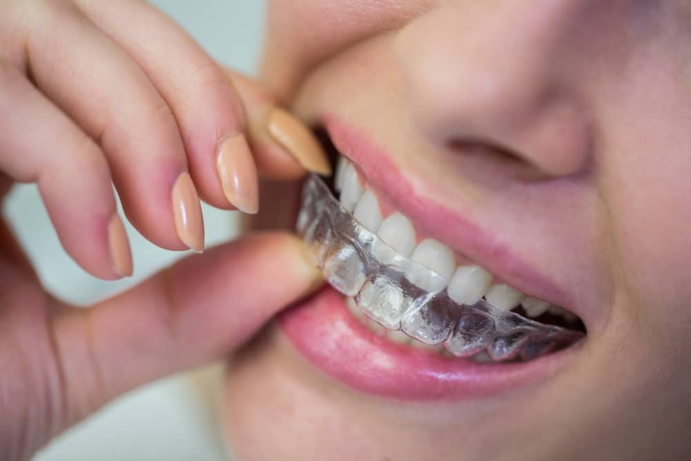 Can I get Invisalign if I have crowns or veneers?
