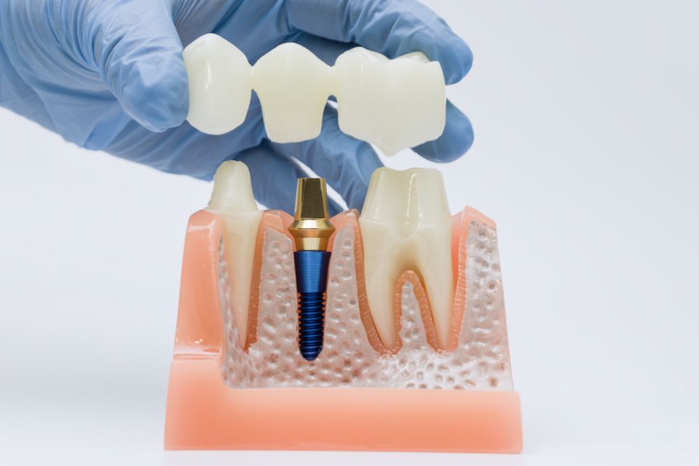 caring for a dental bridge